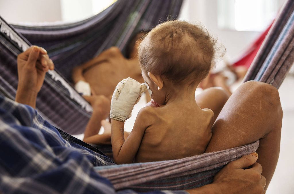 FOLHA DE SÃO PAULO: Crianças yanomamis são intubadas em UTI de Boa Vista com desnutrição grave e longe dos pais