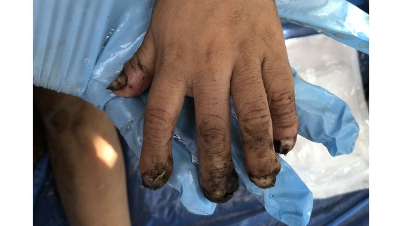 AMAZÔNIA NOTÍCIA E INFORMAÇÃO: Tungíase: como ‘bicho de pé’ faz yanomamis sofrerem amputações e afeta até animais